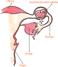 grossesse-extra-uterine